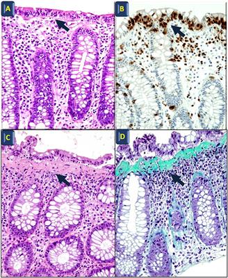 Biomarkers and Microscopic Colitis: An Unmet Need in Clinical Practice